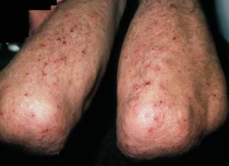 Phân biệt và điều trị bệnh viêm da dạng herpes của Duhring-Brocq viêm da dạng herpes