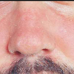 Điều trị viêm da dầu