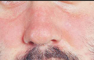 Điều trị viêm da dầu