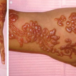 Nguyên nhân và biểu hiện viêm da cơ địa