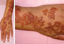 Nguyên nhân và biểu hiện viêm da cơ địa