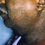 Biểu hiện và các dạng viêm da dị ứng