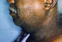 Biểu hiện và các dạng viêm da dị ứng