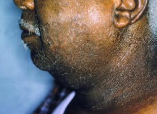 Biểu hiện và các dạng viêm da dị ứng