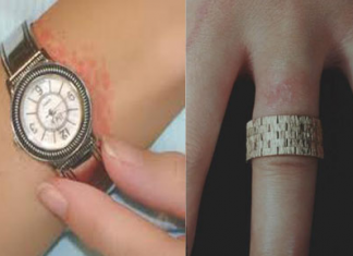 Điều trị và dự phòng viêm da tiếp xúc dị ứng