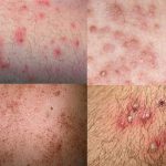 Điều trị và phòng viêm nang lông viêm nang lông