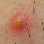 Nguyên nhân và biểu hiện viêm nang lông