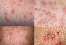 Điều trị và phòng viêm nang lông viêm nang lông