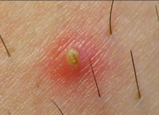 Nguyên nhân và biểu hiện viêm nang lông