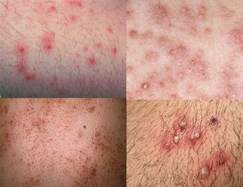 Điều trị và phòng viêm nang lông viêm nang lông