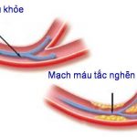 Những yếu tố nguy cơ gây xơ vữa động mạch.