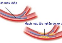 Những yếu tố nguy cơ gây xơ vữa động mạch.