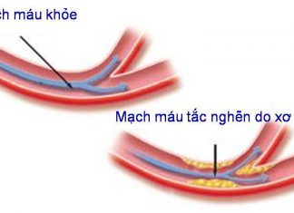 Những yếu tố nguy cơ gây xơ vữa động mạch.