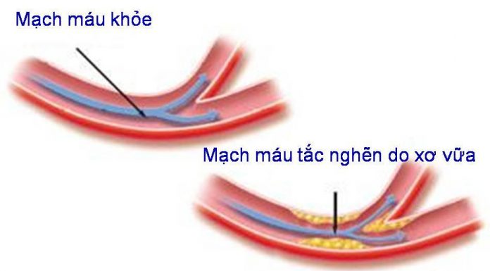 Những yếu tố nguy cơ gây xơ vữa động mạch.