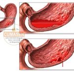 Kỹ thuật nội soi điều trị loét dạ dày tá tràng chảy máu
