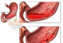 KHÁI QUÁT VỀ CHẢY MÁU TIÊU HÓA CAO. NHỮNG NGUYÊN NHÂN TỪ THỰC QUẢN VÀ BỆNH CHẢY MÁU