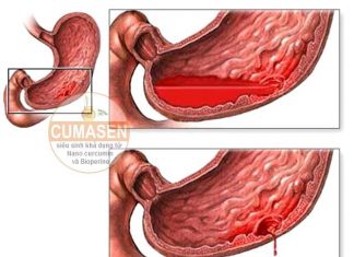 Nguyên nhân từ dạ dày – tá tràng, Chảy máu từ mật – tụy trong xuất huyết tiêu hóa cao