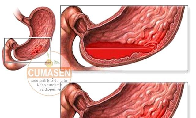 Nguyên nhân dẫn đến viêm dạ dày mãn tính.