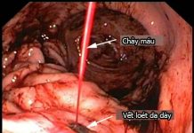 Chẩn đoán xuất huyết tiêu hóa cao