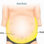 Một số nguyên nhân gây phù khu trú.