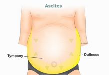 Phân biệt hiện tượng phù do suy dinh dưỡng, suy tim và xơ gan.