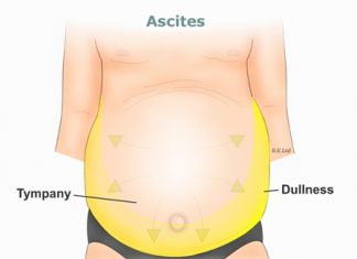 Phân biệt hiện tượng phù do suy dinh dưỡng, suy tim và xơ gan.