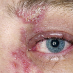 Điều trị bệnh Zona