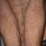 Bệnh á vảy nến thể mảng