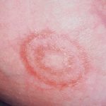 Một số bệnh về da