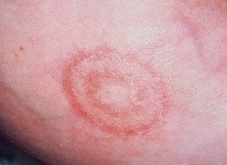 Một số bệnh về da