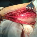 Động mạch cánh tay có cấu trúc giải phẫu ra sao hay cùng tìm hiểu