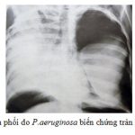 NHỮNG KHUYẾN CÁO VỀ DỊCH TỄ VÀ ĐIỀU TRỊ BỆNH VIÊM PHỔI