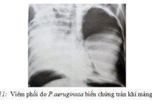 NHỮNG KHUYẾN CÁO VỀ DỊCH TỄ VÀ ĐIỀU TRỊ BỆNH VIÊM PHỔI