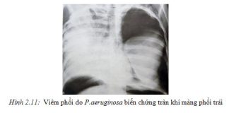 NHỮNG KHUYẾN CÁO VỀ DỊCH TỄ VÀ ĐIỀU TRỊ BỆNH VIÊM PHỔI