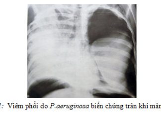 NHỮNG KHUYẾN CÁO VỀ DỊCH TỄ VÀ ĐIỀU TRỊ BỆNH VIÊM PHỔI