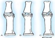 Đặc điểm và vị trí giải phẫu của tất cả các xương bàn tay