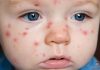 Định nghĩa, phân loại sốt phát ban và căn nguyên virus gây sốt phát ban