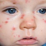 Định nghĩa, phân loại sốt phát ban và căn nguyên virus gây sốt phát ban