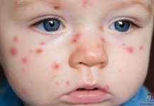 Định nghĩa, phân loại sốt phát ban và căn nguyên virus gây sốt phát ban