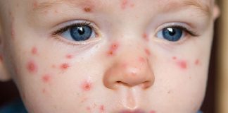 Định nghĩa, phân loại sốt phát ban và căn nguyên virus gây sốt phát ban