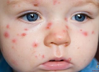 Định nghĩa, phân loại sốt phát ban và căn nguyên virus gây sốt phát ban