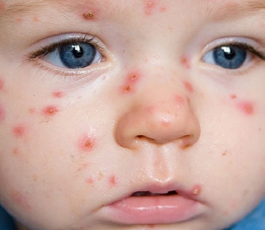 Định nghĩa, phân loại sốt phát ban và căn nguyên virus gây sốt phát ban