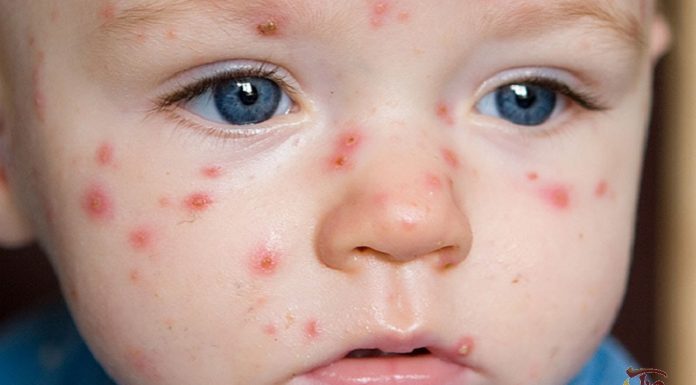 Định nghĩa, phân loại sốt phát ban và căn nguyên virus gây sốt phát ban