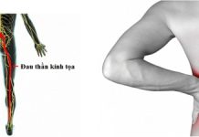 Những nguyên nhân dẫn tới đau dây thần kinh hông to (phần 1)