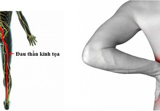 Những nguyên nhân dẫn tới đau dây thần kinh hông to (phần 2)