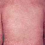 Một số thể đỏ da toàn thân