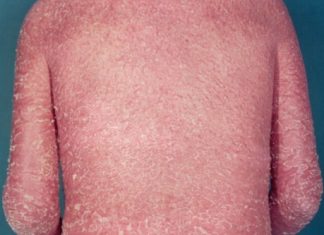 Một số thể đỏ da toàn thân