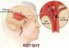 Tai biến mạch máu não đột quỵ
