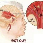 Tai biến mạch máu não đột quỵ